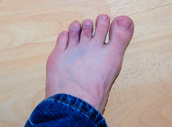 Bruised Toes